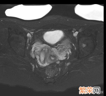 什么是阴道斜隔综合征？