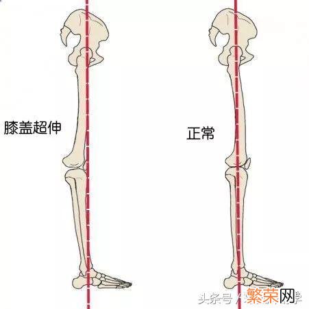 是什么导致膝超伸 膝超伸是什么样子