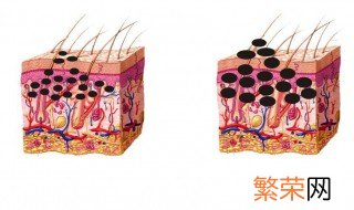 怎样才能祛斑 祛斑的方法