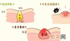 怎样处理青春痘 处理青春痘的方法