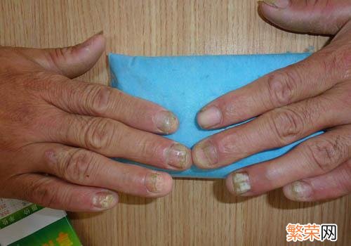 灰指甲会传染别人吗,还是自身传染 灰指甲会传染别人吗