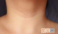 颈纹怎么消除简单方法 消除颈纹的方法