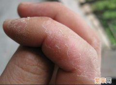 脂溢性皮炎和湿疹的区别 皮炎和湿疹的区别