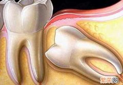 智齿一定要拔吗 智齿一定要拔吗不拔会怎么样
