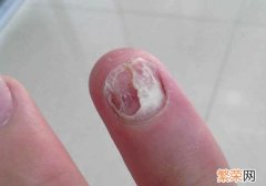 手足口病指甲脱落是什么原因 指甲脱落是什么原因