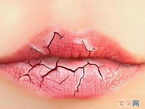 怎么预防嘴唇干裂 怎么预防嘴唇干裂出血