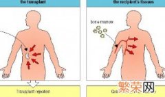 gvhr医学上是什么意思 gvhr医学上的意思