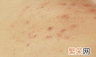 皮肤各部位出现小痘痘是怎么回事 皮肤各部位出现小痘痘是怎么回事图片