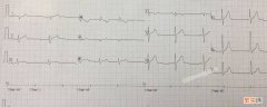 心电图怎么看左心室高电压 心电图怎么看