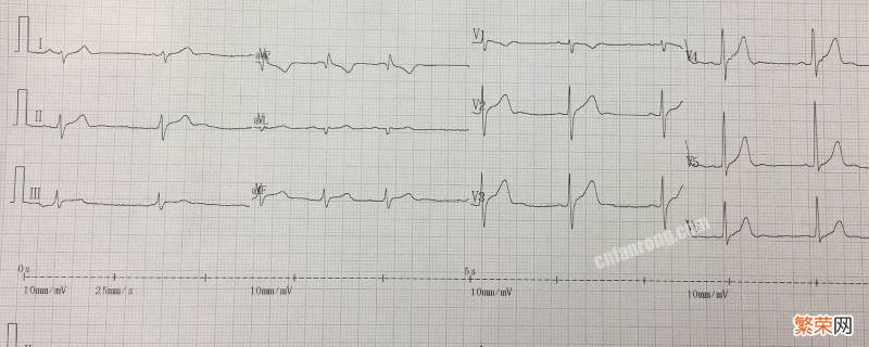 心电图怎么看左心室高电压 心电图怎么看