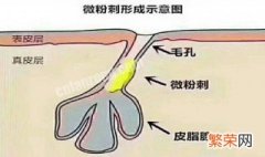 如何有效应对毛孔堵塞 如何有效应对毛孔堵塞的问题