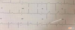 下壁t波改变是什么意思 t波改变是什么意思？