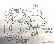 注射空气会死亡吗？