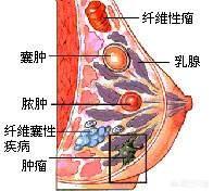 乳腺结节、乳腺囊肿和乳腺纤维瘤,哪个危害更大？