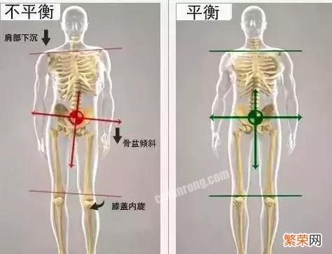 骨盆侧倾最佳的矫正方法是什么？