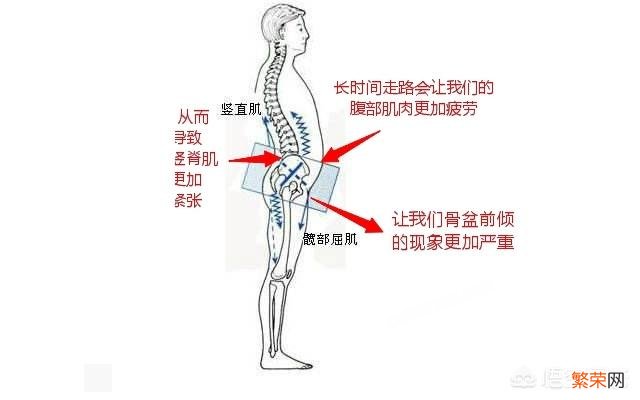 走路能够改善骨盆前倾吗？