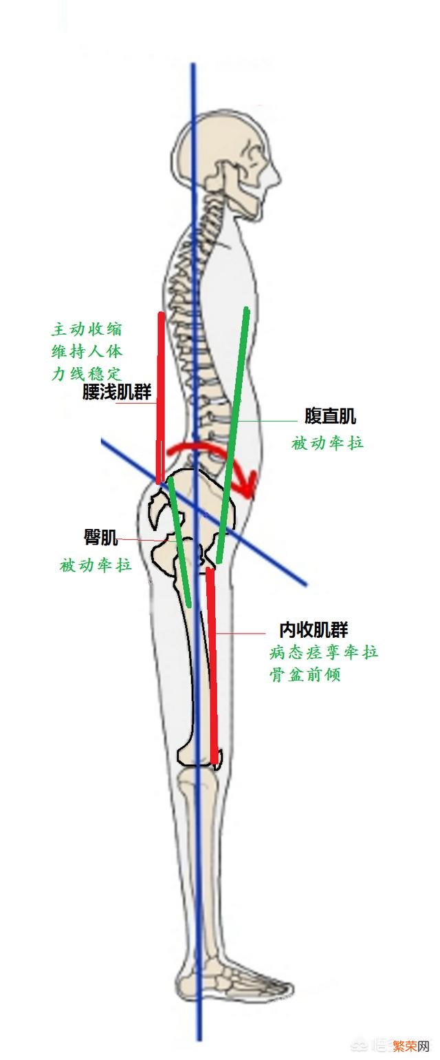 腰突并有骨盆前倾症状的人该怎样锻炼呢？