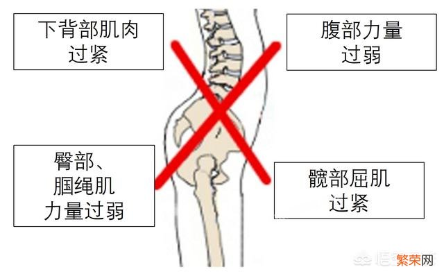 腰突并有骨盆前倾症状的人该怎样锻炼呢？