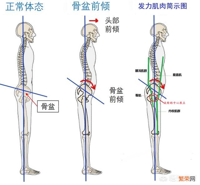 腰突并有骨盆前倾症状的人该怎样锻炼呢？