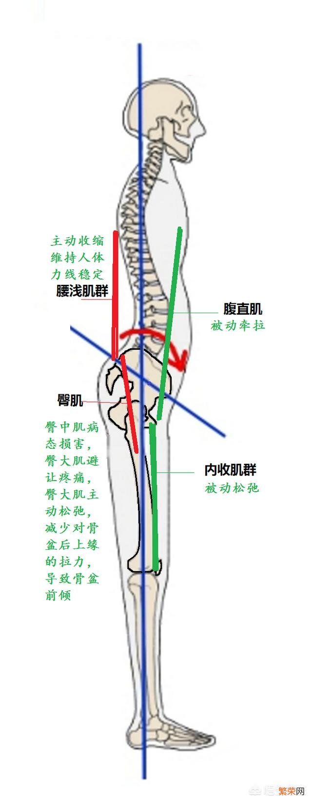 腰突并有骨盆前倾症状的人该怎样锻炼呢？