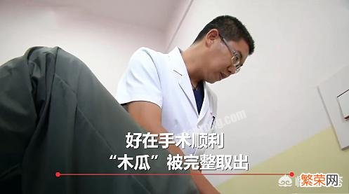 陕西男子腹痛,从体内取出20厘米木瓜。医生惊呆,咋回事？