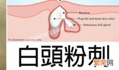 脸上长粉刺是什么原因怎样去掉 脸上长粉刺是什么原因怎样去掉图片