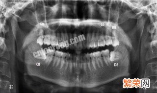 如何判断自己长智齿了 如何判断自己长智齿了还是上火
