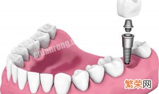牙齿修复方法有几种 牙齿修复方法