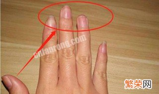 指甲有竖纹的解决办法 指甲有竖纹的解决办法有哪些
